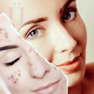 Tratamiento Facial Antimanchas