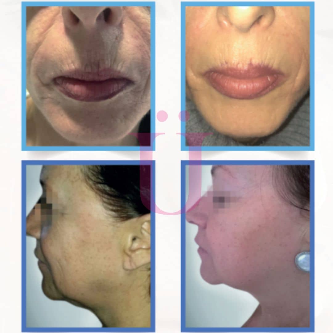 ULTRASONIX FACIAL